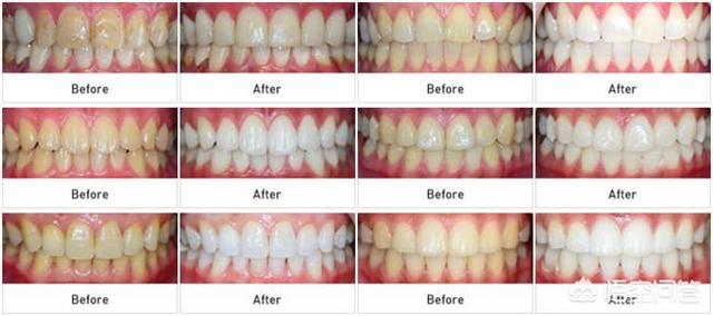 如何有效预防牙齿变黄，早晚都刷牙，为啥牙齿还是黄牙