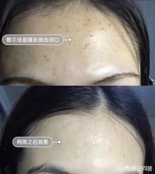 去痤疮面膜(去痤疮面膜牌子)