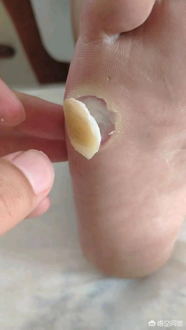 头条问答 - 两个脚底和大脚趾有很厚的底茧子,发黄发硬,走路疼,该怎么
