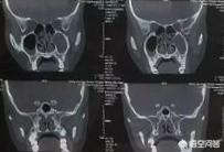 鼻炎有哪些症状怎么治:鼻炎、鼻窦炎、过敏性鼻炎有哪些区别？