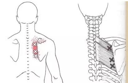 头条问答 - 最近右侧肩膀和后背疼,是什么原因?(四如居士的回答,0赞)