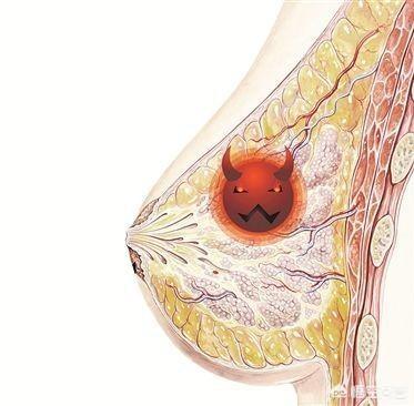 乳房结节指的是:乳腺内的小肿块,包括良性的纤维瘤,导管内乳头状瘤