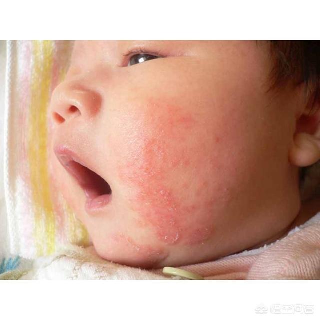 宝宝皮肤干燥、脱皮、起红点还痒，好像是湿疹，该怎么治疗？