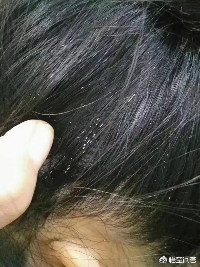 头条问答 - 头发上有白色小点,为什么呀,怎样才能去除?(1个回答)