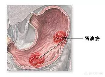 牛奶蛇蛇图片大全:胃溃疡、胃糜烂，喝什么奶比较好？ 牛奶蛇蛇的图片