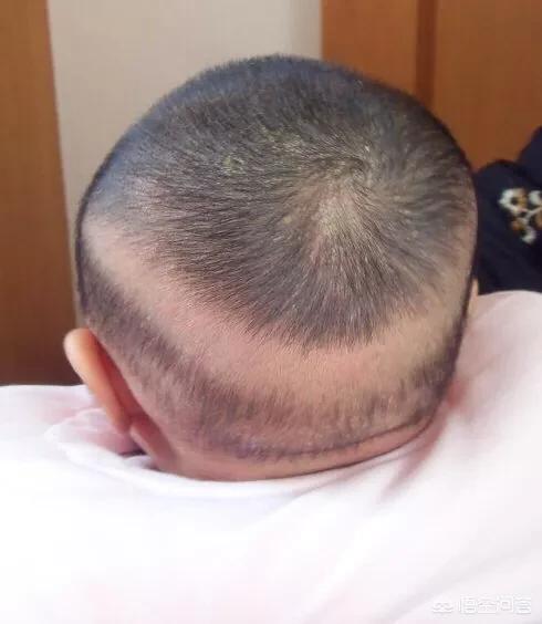 新生儿婴儿脑后勺头发秃光,流传的说法是缺钙,真的是如此吗?