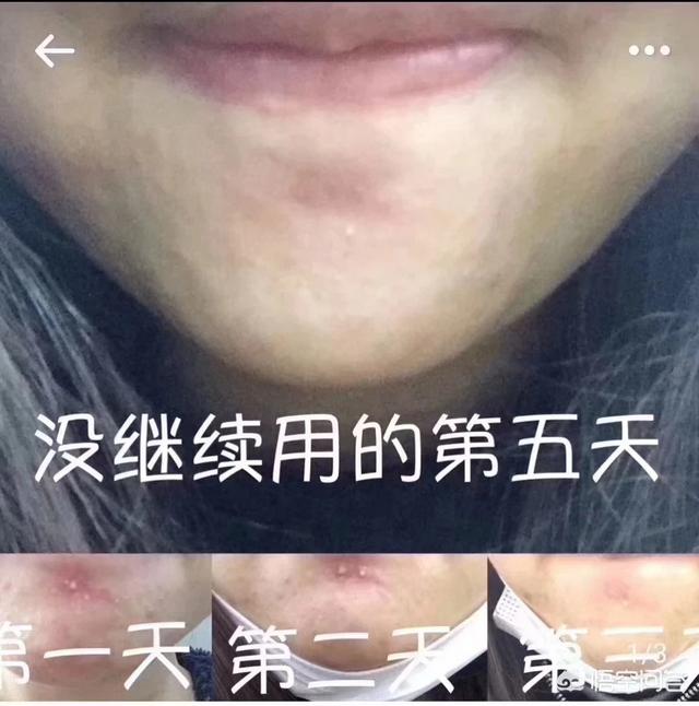 去痤疮面膜(去痤疮面膜牌子)