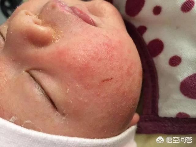 婴儿湿疹起皮可以涂山茶油滋润吗？(婴儿湿疹可以涂茶油吗)