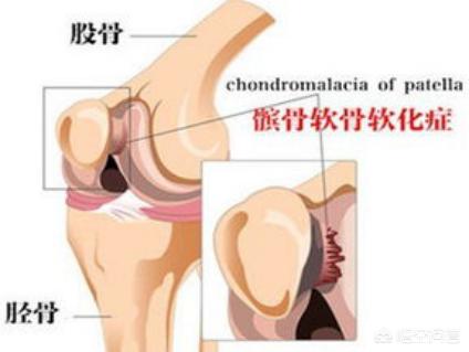 膑骨术练股四头肌:膝盖骨可以用手推动正常吗？