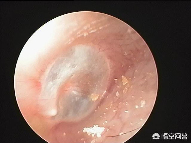 头条问答 - 鼓膜为什么会内陷,对听力有什么影响?(89个回答)