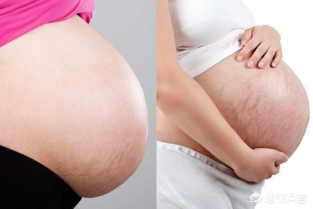 怀孕多久会长妊娠纹？为什么会长妊娠纹？插图13