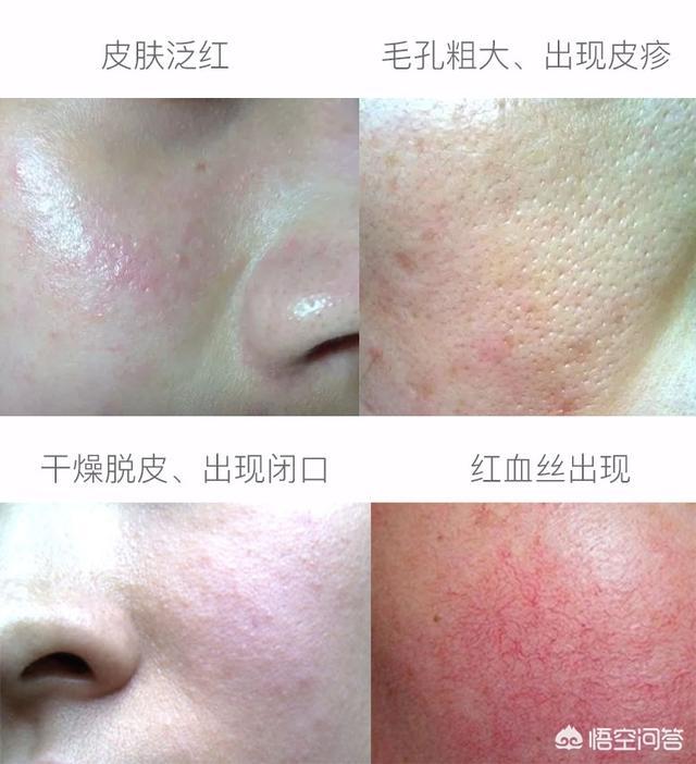 作激光能净化血液吗:脸上的红血丝可以去掉吗？