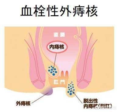 头条问答 痔疮对人有什么影响 普外科曾医生的回答 0赞