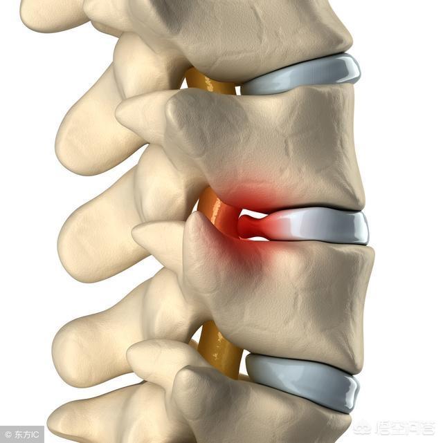 老公腰椎4-5节突出,两节滑脱,椎管狭窄,现在脊柱已经变形了,你认为