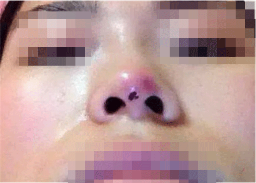 鼻尖整形整容手术;韩国鼻子整形整容手术