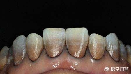 如何有效预防牙齿变黄，早晚都刷牙，为啥牙齿还是黄牙