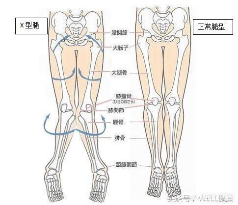 XO腿有哪些缺点，什么是X型腿如何评估X型腿