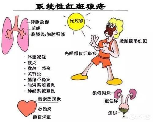 宝宝系统性红斑狼疮症状图片:紫癜与系统性红斑狼疮症状图片 红斑狼疮不可以吃哪些水果？