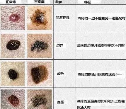 面痣图女子怎么看待脸上痣很多的人呢