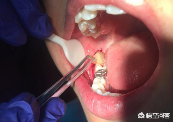 头条问答 - 拔牙后一周还在痛,该怎么冶疗?(3个回答)
