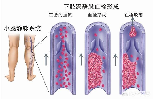 老年人长期吃太咸的危害:有些老年人吃咸的食物为什么脚会肿起来？