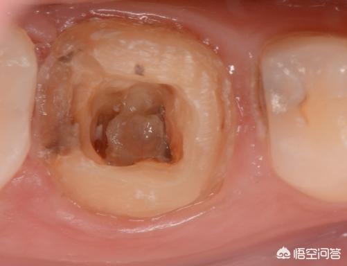 头条问答 - 根管治疗一周后牙开始疼该怎么办?(4个回答)
