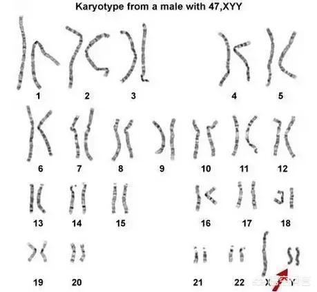 超y牝犬姊妹花1_10:染色体为XYY的人是什么样的？