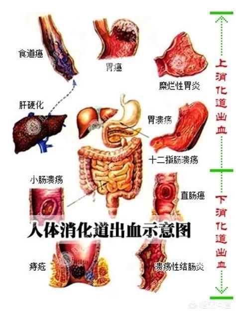 阑尾炎术后一痛就便血是什么原因,阑尾炎术后肚痛便血是什么原因