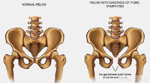耻骨疼痛究竟有多苦不堪言，怀孕耻骨疼是不是好生，这是真的吗