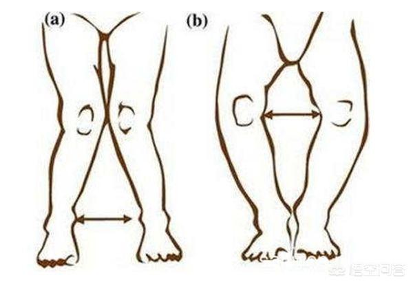小宝缺钙会造成外八字脚吗:怎么快速纠正走路外八字？