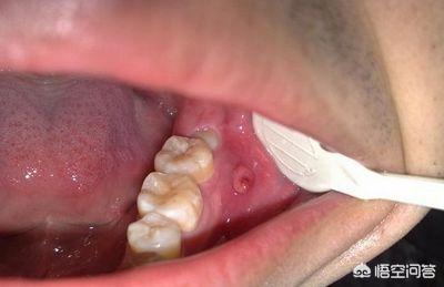2,还有一种是根尖周炎,牙龈会有脓包出现,脓液聚集越多,将牙齿顶起,有