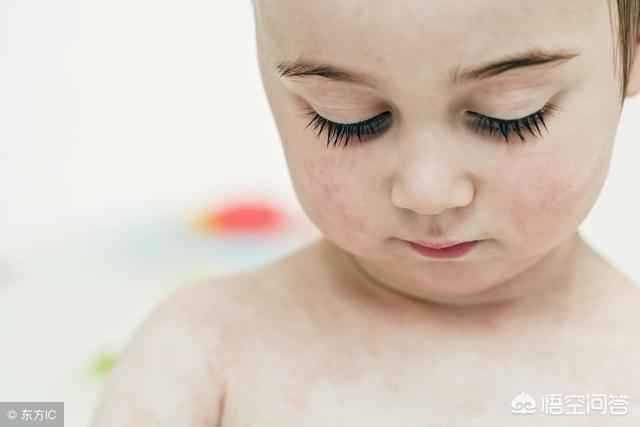 刚满月的宝宝脸上长了湿疹，该怎么治疗？