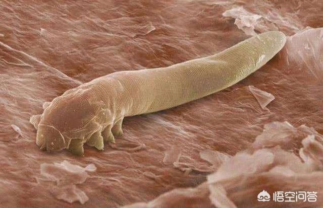 头条问答 - 黑头挤出来是白色长条状,是不是螨虫引起的呢?(6个回答)