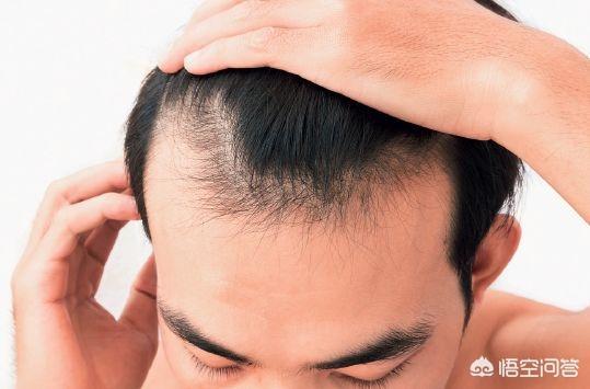 年轻人脱发原因(年轻人脱发原因脂溢性脱发怎么办)