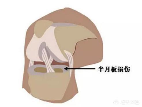 膝盖半月板骨裂怎么办:膝半月板撕裂怎样治疗 双腿半月板损伤，现在一走路就裂开痛，且有声响，怎么办？