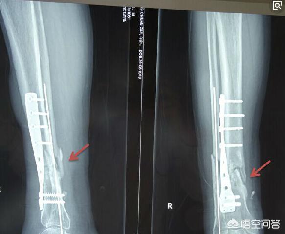 头条问答 胫腓骨开放性骨折 手术后一般多久开始长骨痂 恢复期需要注意什么 5个回答