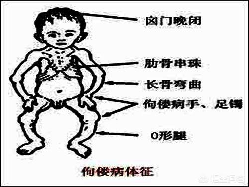 活动性佝偻病症状:佝偻病早期的三大症状?厂？