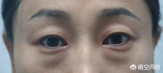 怎样消除眼袋又快又好维生素e去眼袋可行吗