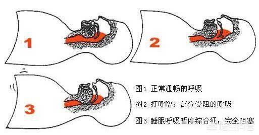 为什么会打呼噜为什么会打呼噜怎么治