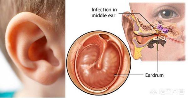 男童感冒后急性中耳炎吃什么药:小儿中耳炎怎么治疗？ ？