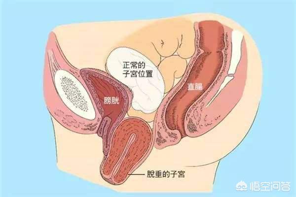 什么是子宫脱垂，子宫脱垂手术风险大吗？要注意什么？