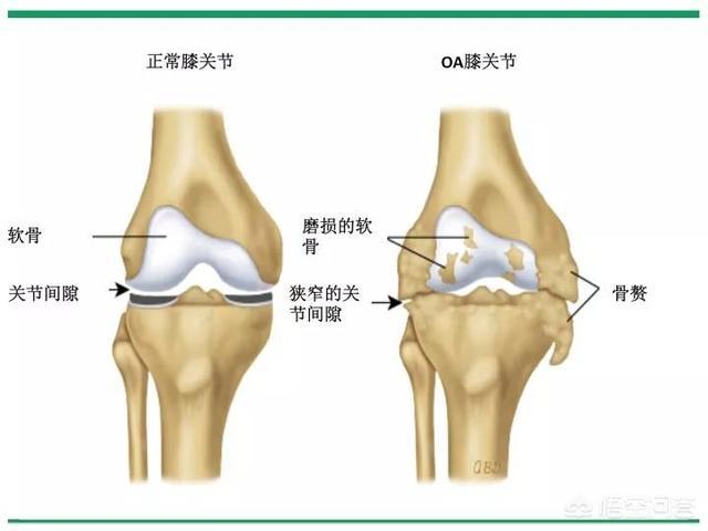 膝盖关节炎症状:患有膝关节骨性关节炎的老人应该如何上下楼梯？