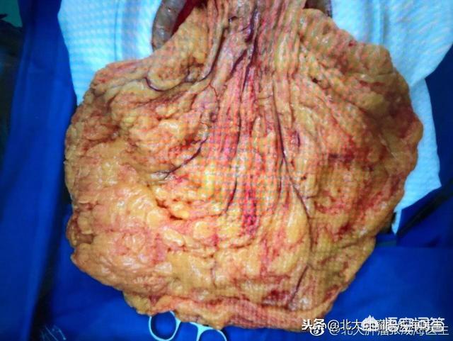 梁海玲到底长啥样:肚子大的肥胖者，肚子里都是什么