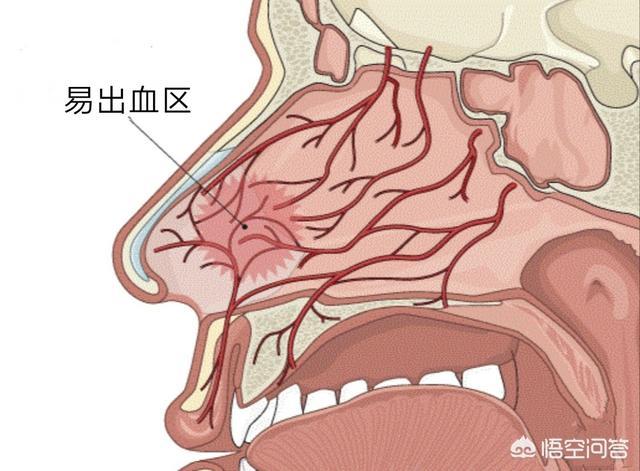 经常流鼻血的原因(经常流鼻血的原因有哪些)