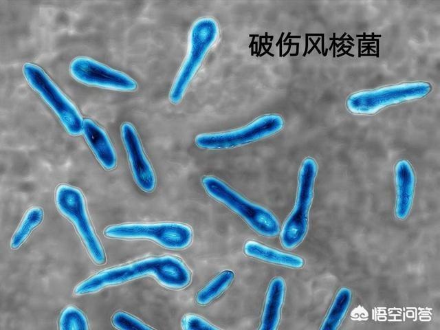 头条问答 - 破伤风是什么?容易得吗?(63个回答)