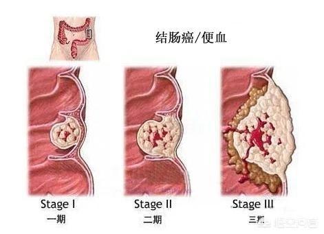 阑尾炎术后一痛就便血是什么原因,阑尾炎术后肚痛便血是什么原因