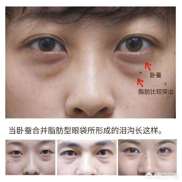 头条问答 泪沟和跟黑眼圈是不同的 如何合理改善泪沟 9个回答