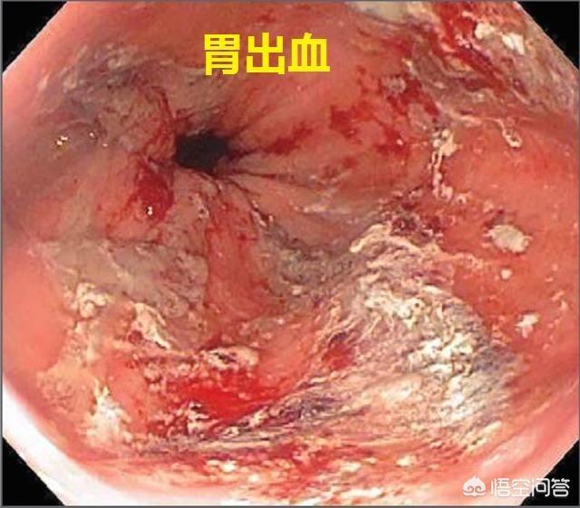 肠道出血:肠道出血 胃出血还是肠出血该如何判定？