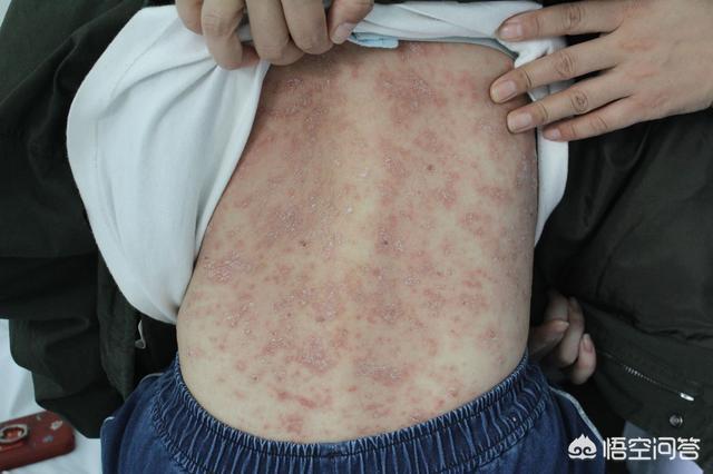 头条问答 - 中老年人银屑病患者饮食方面需要注意什么?(11个回答)