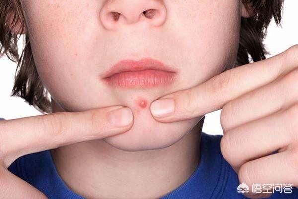 去痤疮面膜(去痤疮面膜牌子)